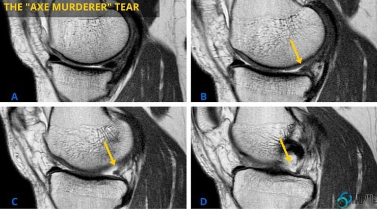 meniscus posterior root tear mri