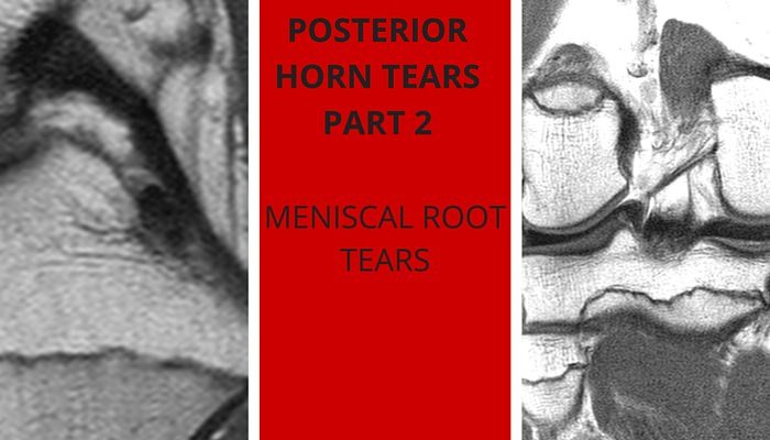 meniscal root tear radiology education asia