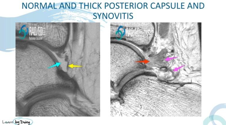 anke posterior impingement capsule and synovitis radiology education asia