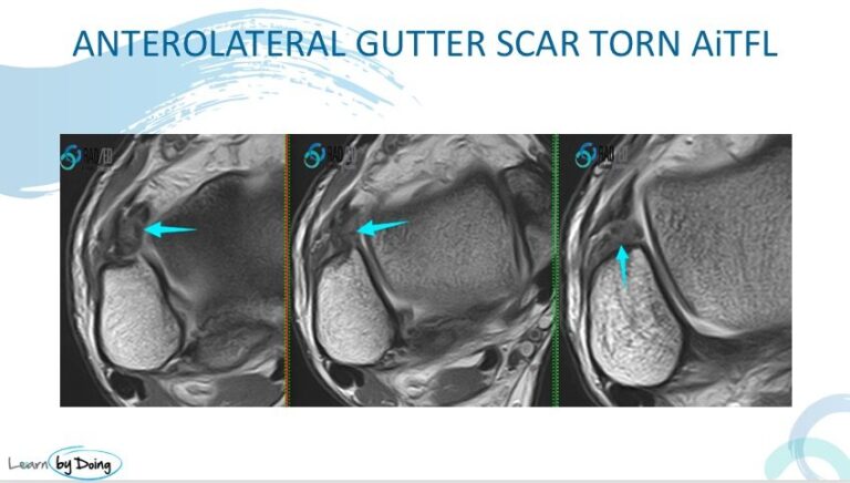 ankle impingement anterolateral scar mri radiology education asia raded asia