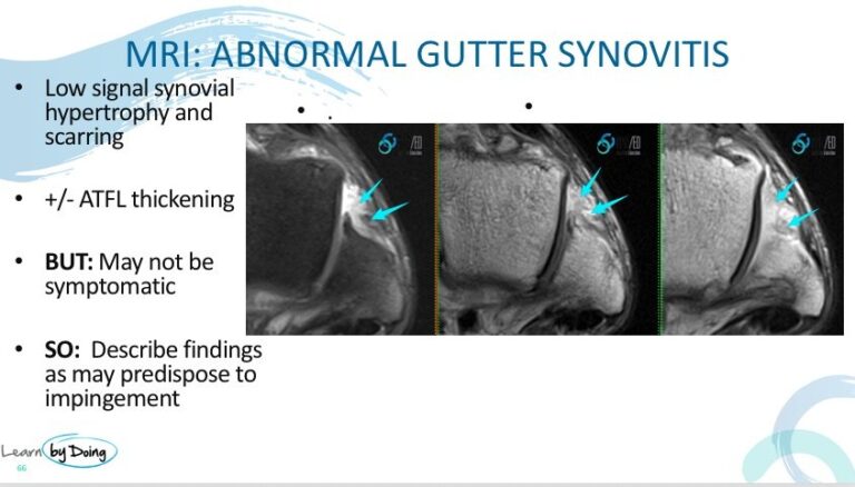 ankle impingement anterolateral synovitis mri radiology education asia raded asia