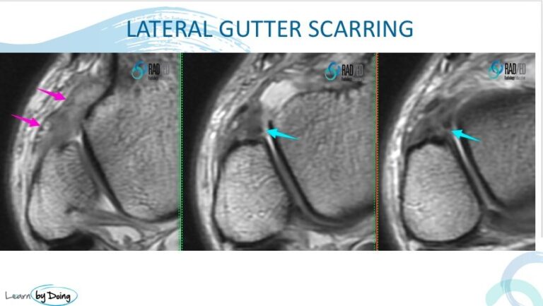 ankle impingement scar anterolateral mri radiology education asia raded asia