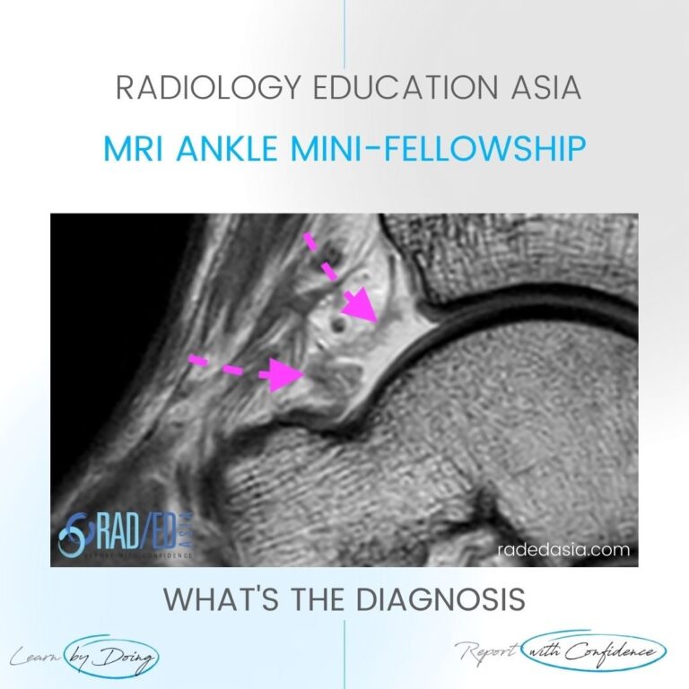 ankle mri synovitis capsulosynovitis