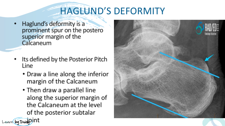 ankle posterior impingement haglunds radiology education asia