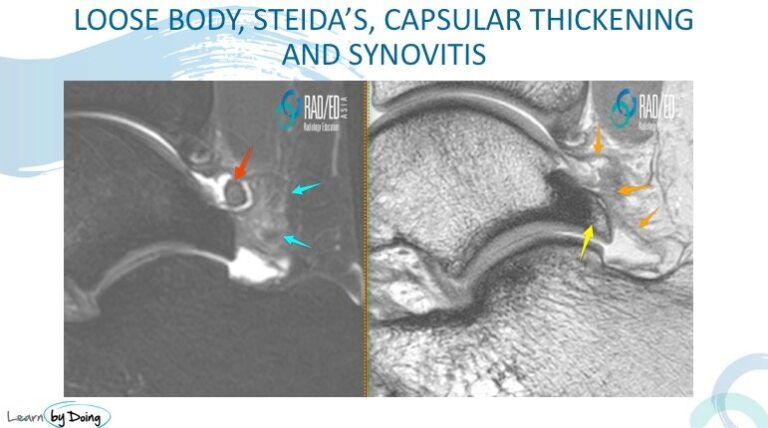 ankle posterior impingement loose body steidas process capsulitis