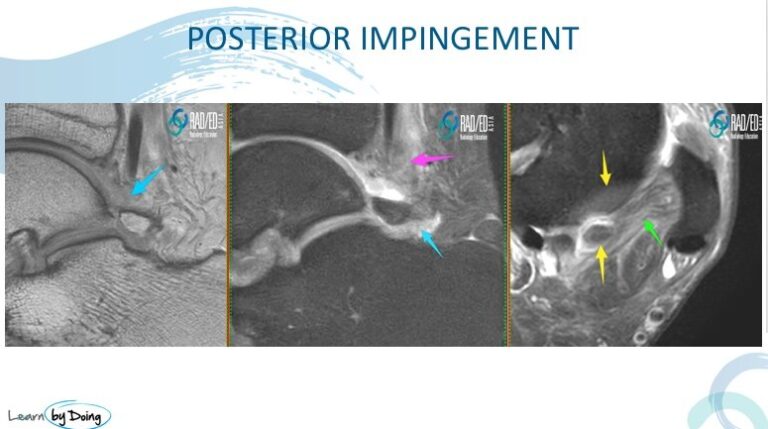 ankle posterior impingement mri findings radiology education asia