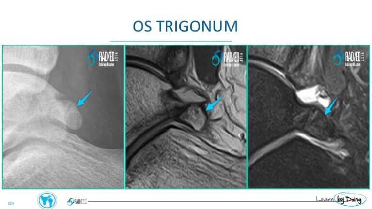 ankle posterior impingement os trigonum radiology education asia