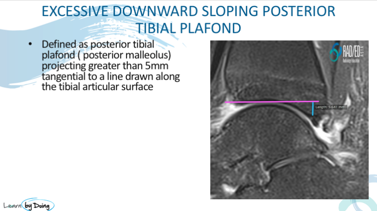 ankle posterior impingement sloping tibial plafond radiology education asia