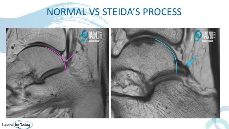 ankle posterior impingement steida vs os trigonum radiology education asia