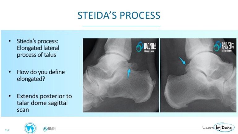 ankle posterior impingement steidas process radiology education asia