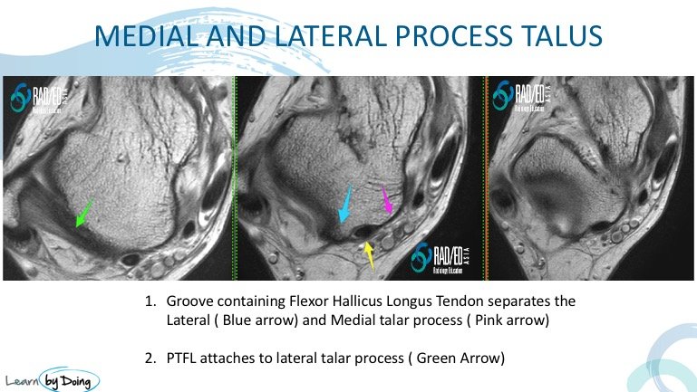 ankle posterior impingement talus lateral process normal radiology education asia