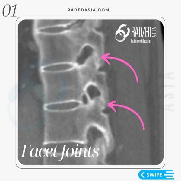 ankylosing spondylitis spine mri ct radiology fusion images