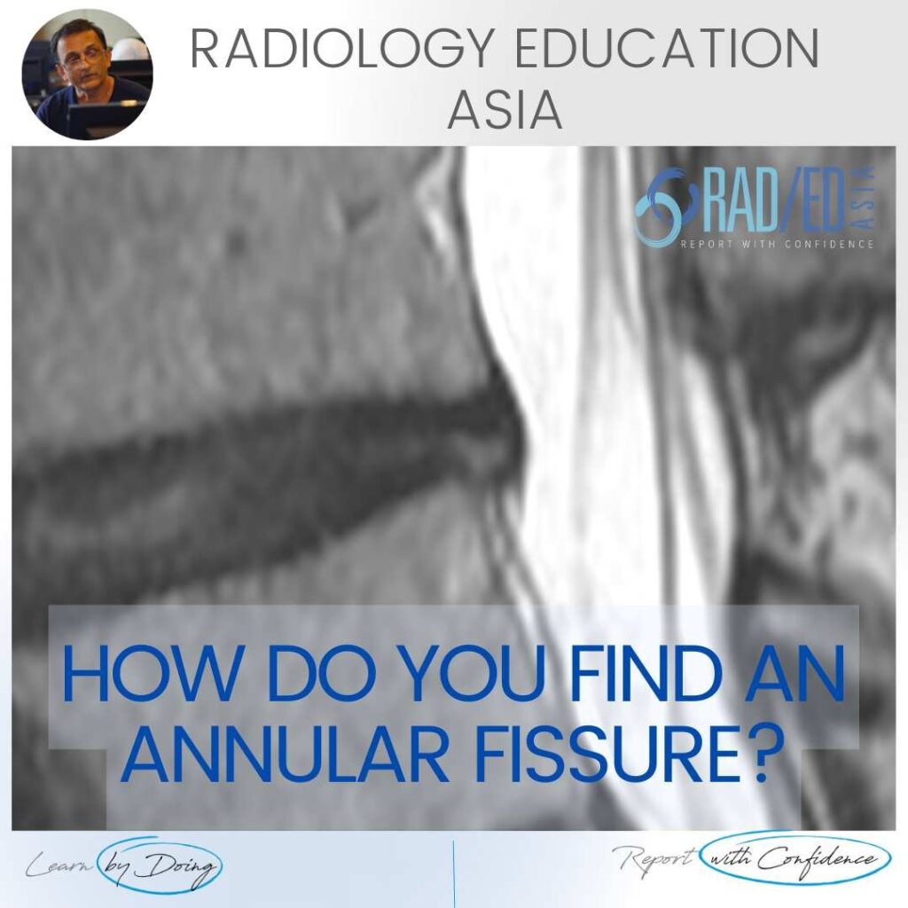 annular fissure tear mri radiology lumbar spine radedasia