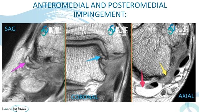 anteromedial impingement bone spur ankle radiology education asia