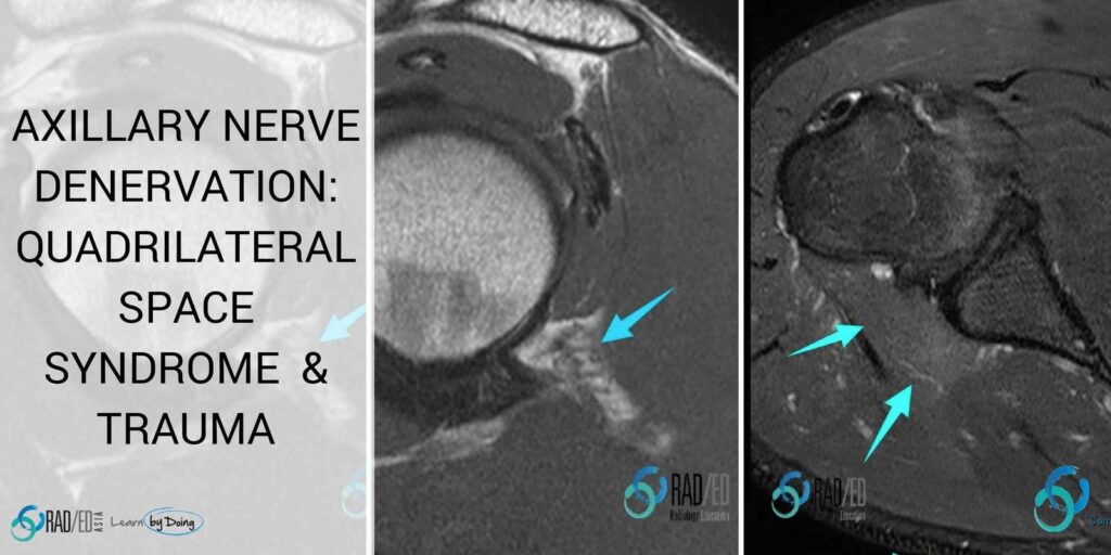 axillary-nerve-denervation-quadrilateral-space-syndroma-dislocation-radiology-education-asia-radedasia