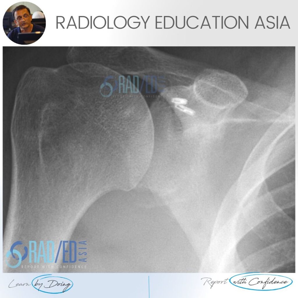 bony bankart xray ct radiology glenoid fracture shoulder dislocation