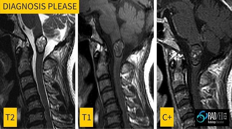 cavernoma-cord-mri-radiology-education