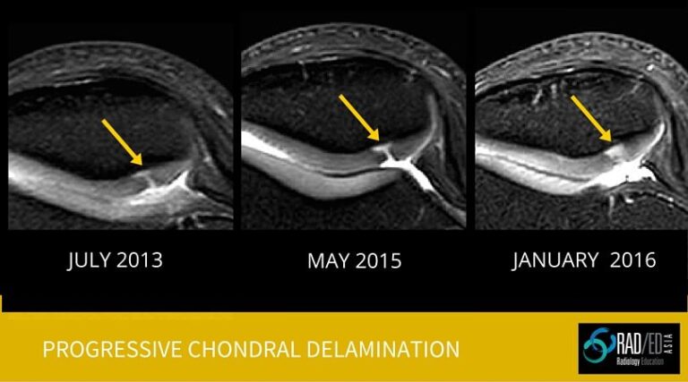 chondral- delamination-mri-radiology-education-radedasia