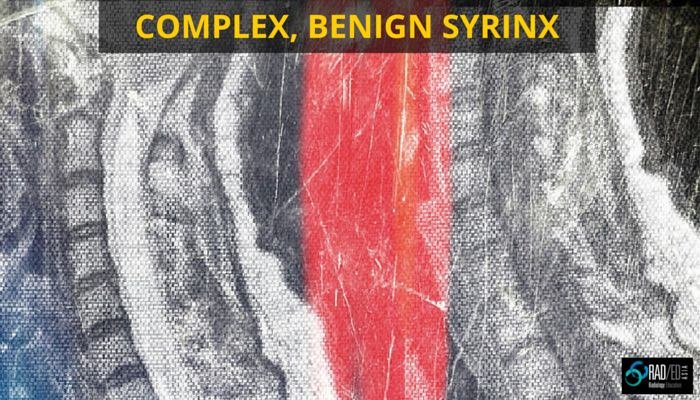 complex benign syrinx radiology education asia radedasia