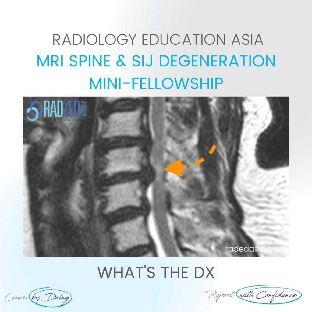 cord signal change spondylotic myelopathy mri