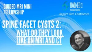 ct mri facet cysts mri spine how to mri facet cysts spine learn spine mri online radiology education asia