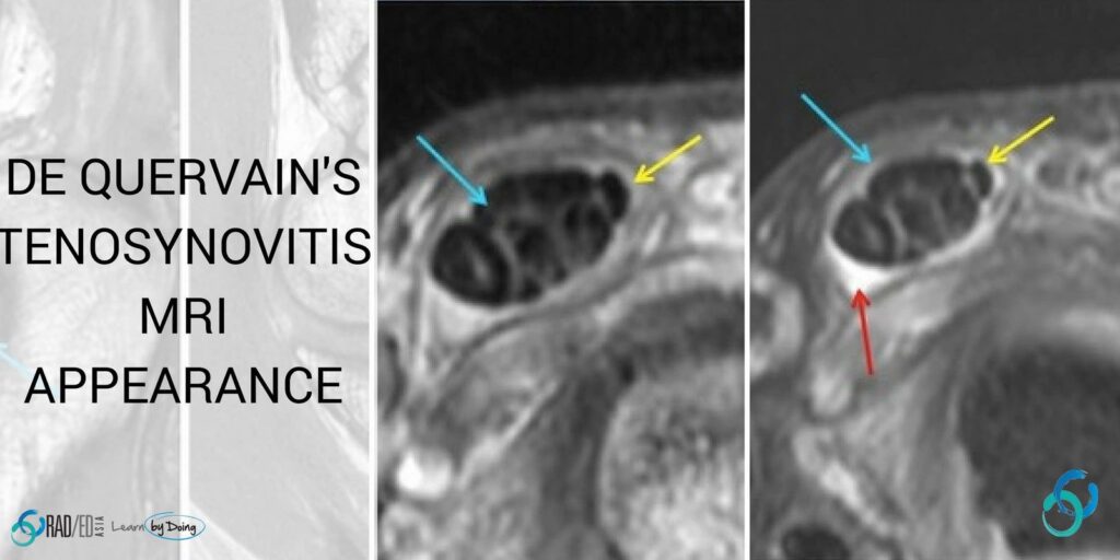 de quervains tenosynovitis mri radiology education asia radedasia