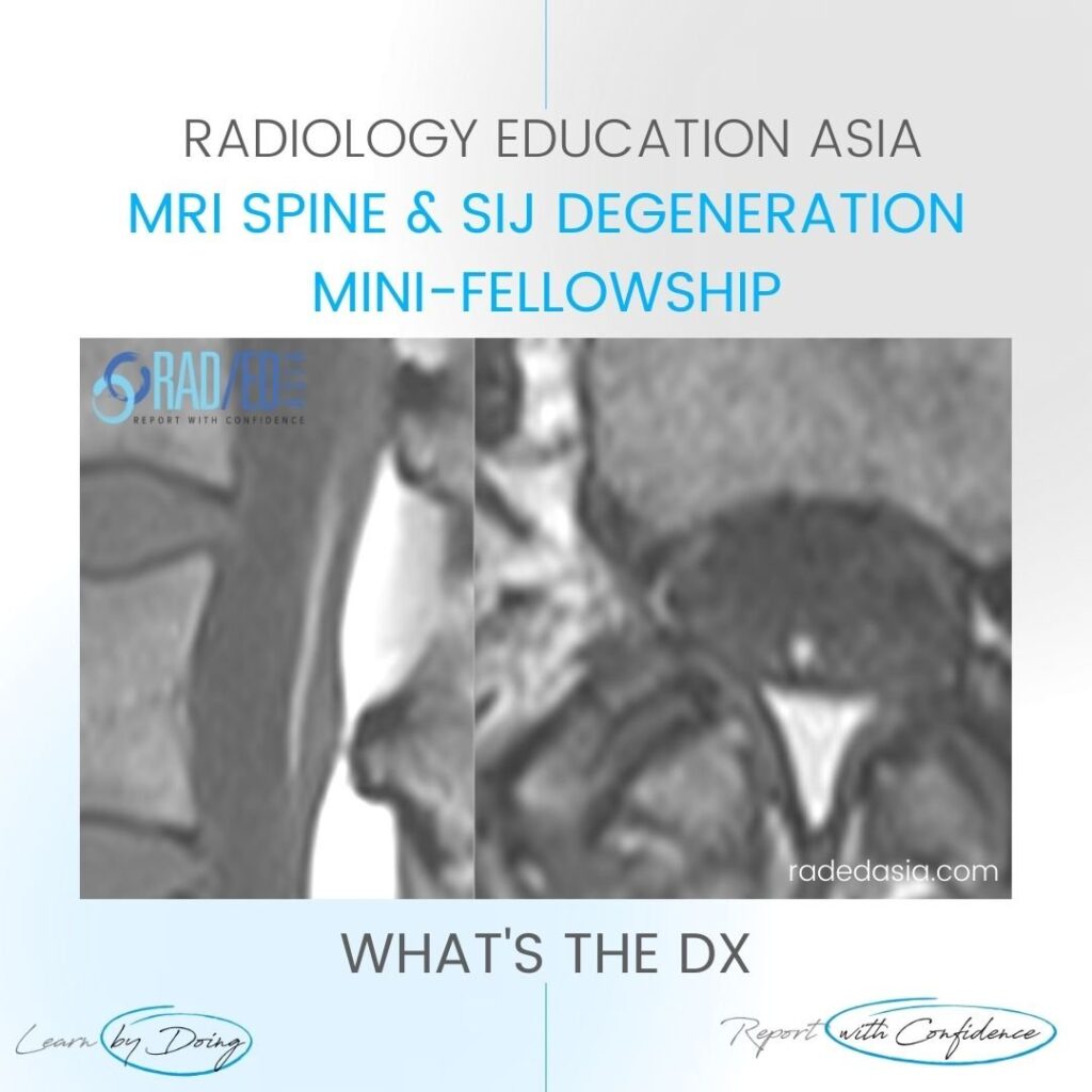 fatty filum mri learn spine radiology