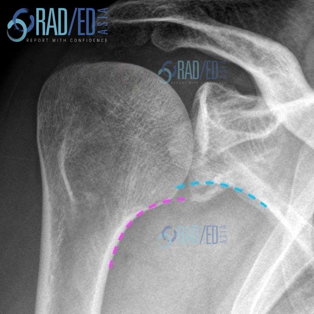 glenohumeral joint humeral subluxation humerus scapulohumeral moloney's line gothic arch mri radiology xray rea radedasia