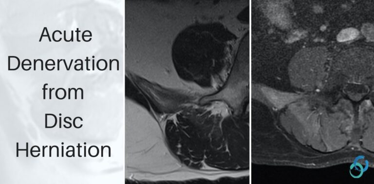 denervation lumbar mri paraspinal