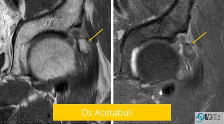 hip fai os acetabuli mri radiology education asia radedasia