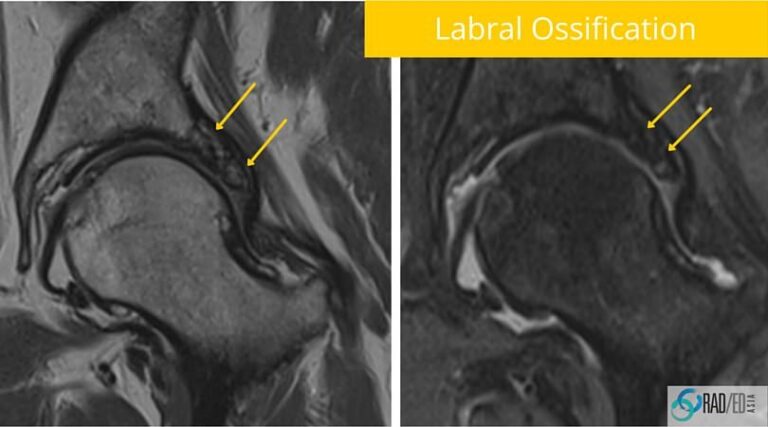 hip labral ossification mri radiology education asia radedasia