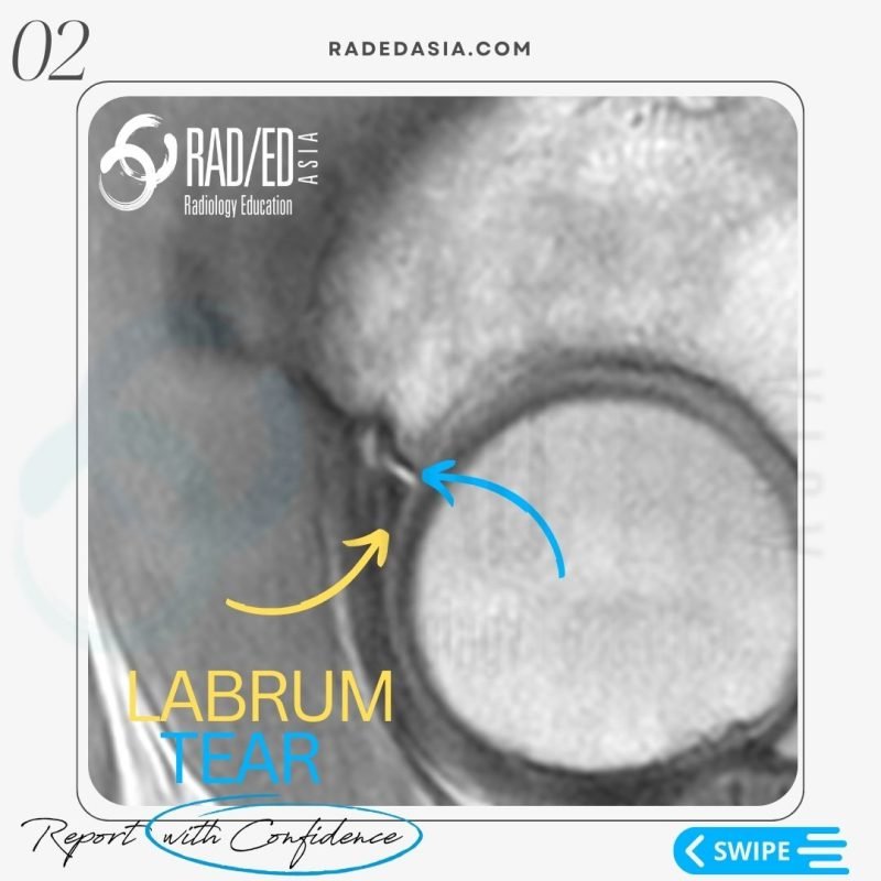 hip labrum labral tear radiology mri radedasia