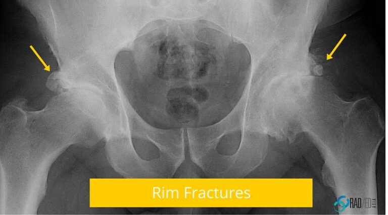 hip rim ossification fracture radiology education asia radedasia