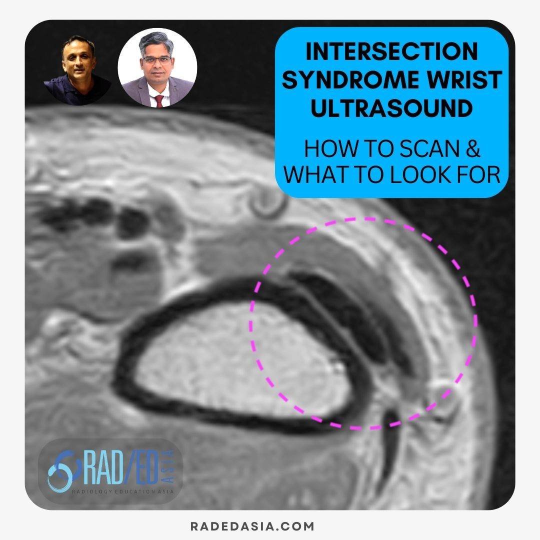 intersection syndrome wrist ultrasound radiology how to scan radedasia