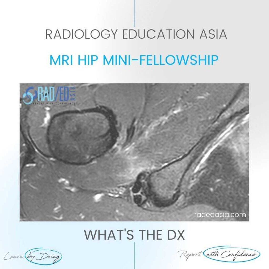 ischiofemoral impingement radiology mri hip