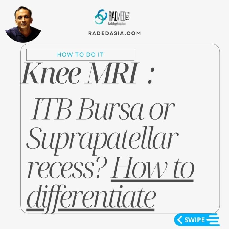 itb iliotibial band friction syndrome bursa radiology mri knee