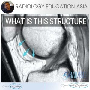 knee infrapatellar plica syndrome radiology mri radedasia