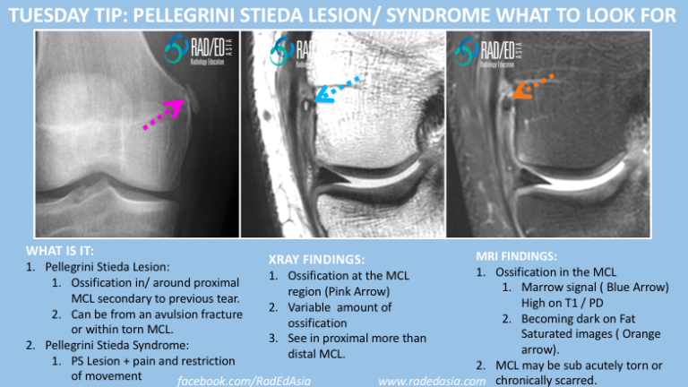 knee mcl pellegrini stieda mri xray radiology education asia radedasia