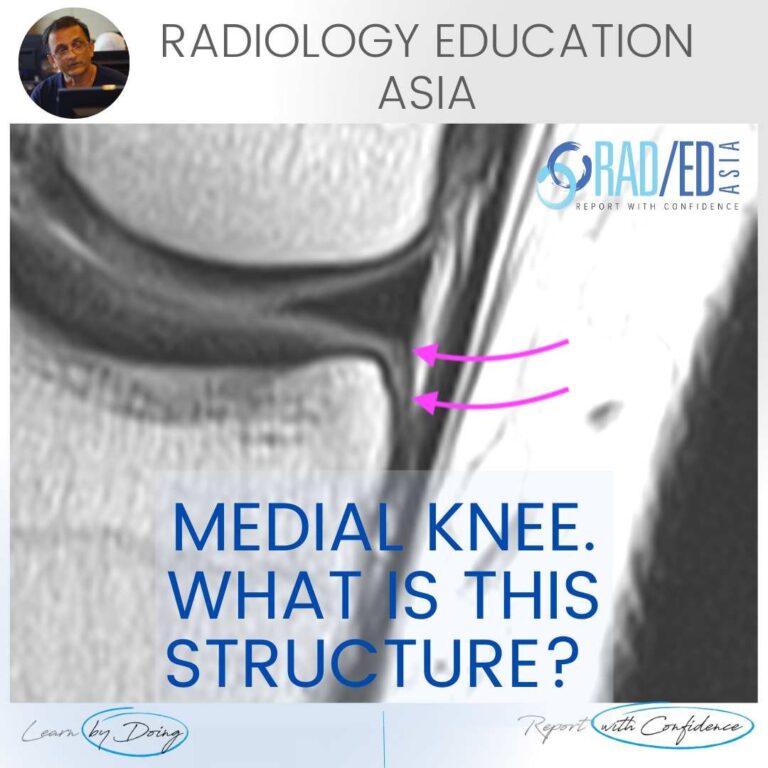 knee mri meniscotibial ligament deep mcl radedasia