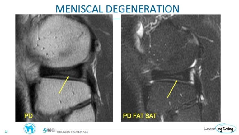 knee mri meniscus degeneration globular tear radiology education asia