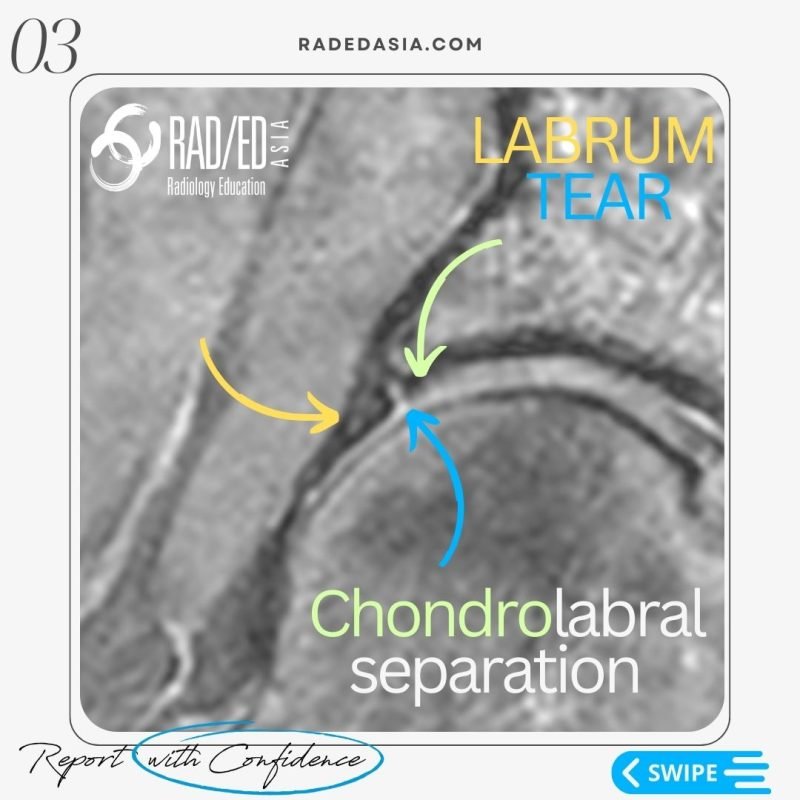 labrum labral tear chondrolabral separation hip mri radiology radedasia