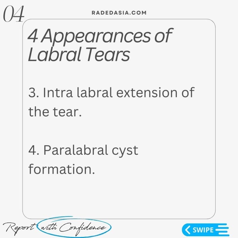 labrum labral tear chondrolabral separation mri hip radiology radedasia