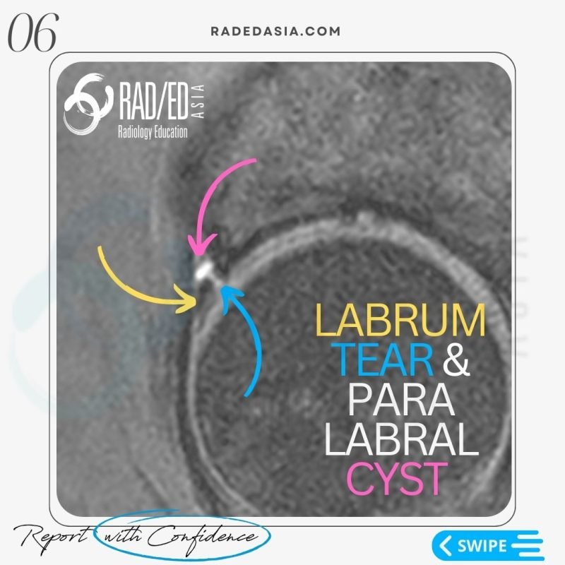 labrum tear intra labral hip mri radiology radedasia