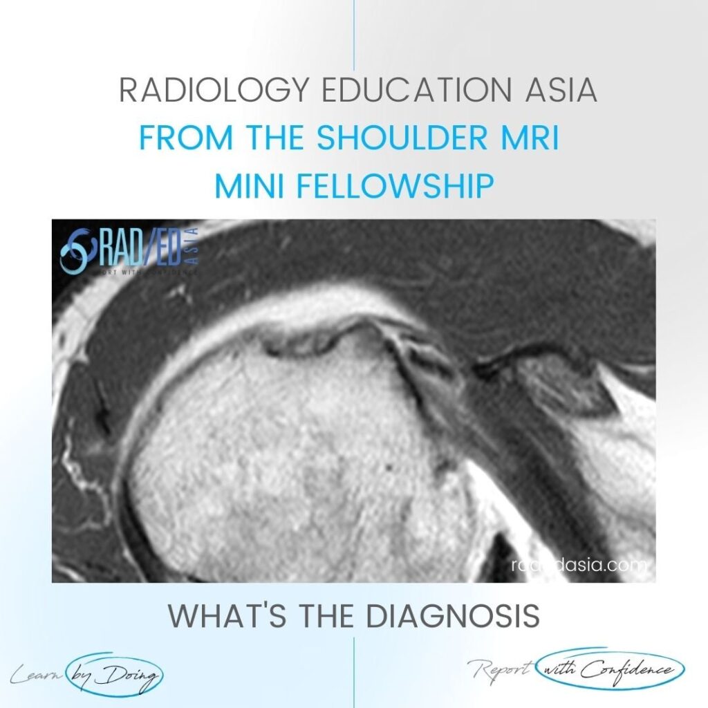 learn shoulder mri biseps disloc cyst radedasia