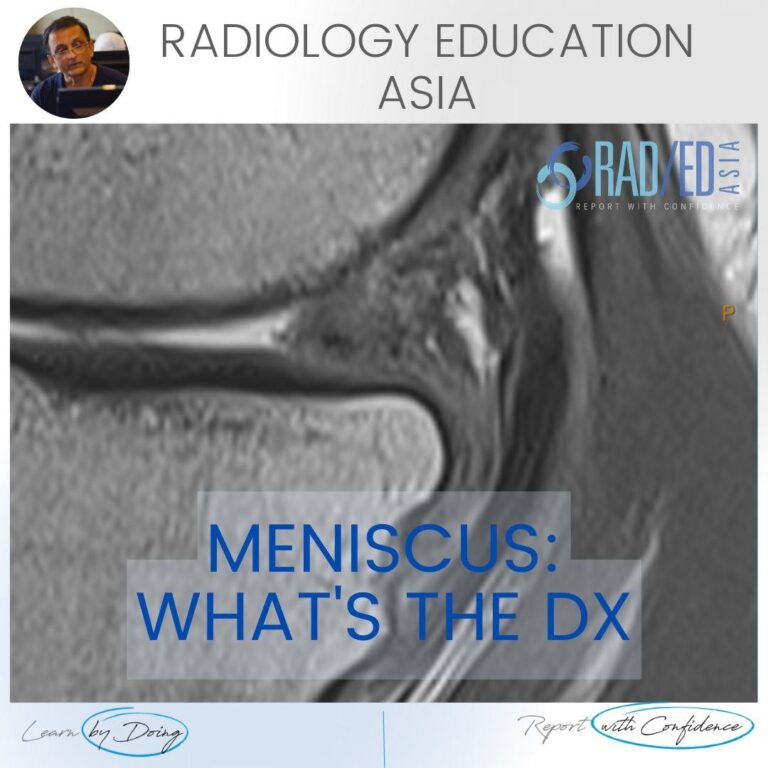 meniscus tear maceration degeneration mri knee radedasia