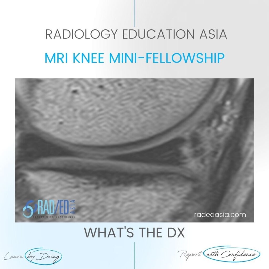 meniscus tear mri vertical knee radedasia