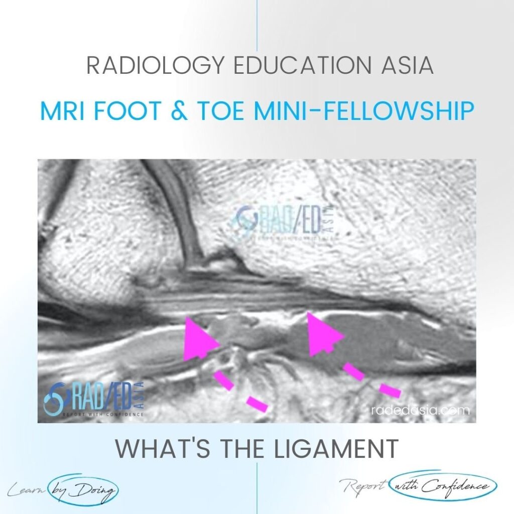 mri ankle foot ligament short plantar