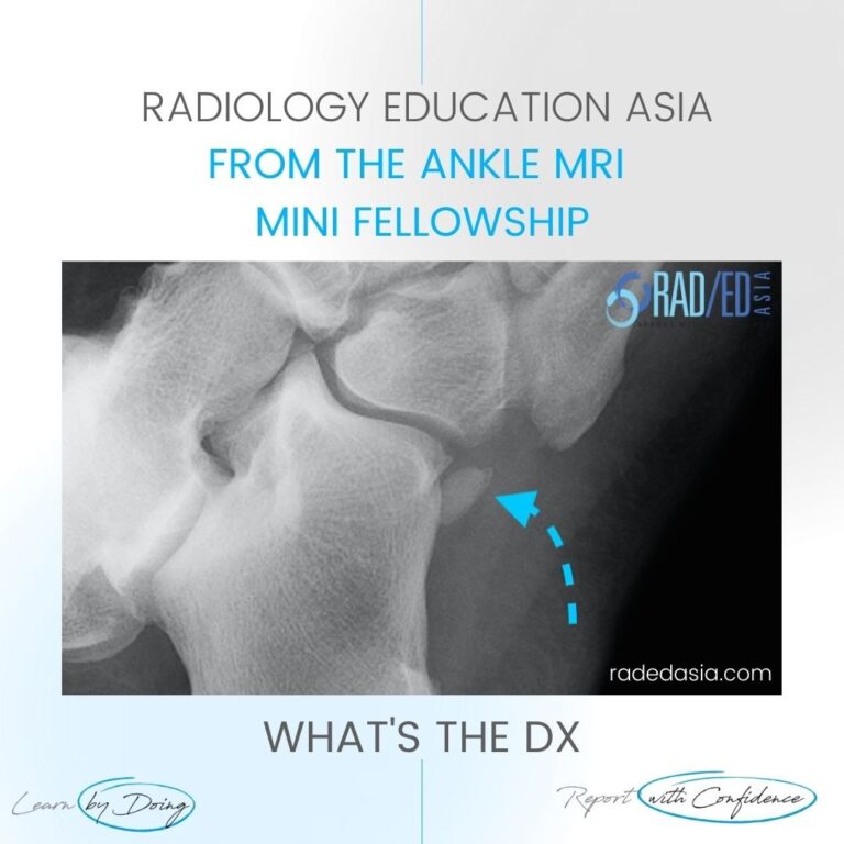 mri ankle os peroneum learn radiology wtd radedasia