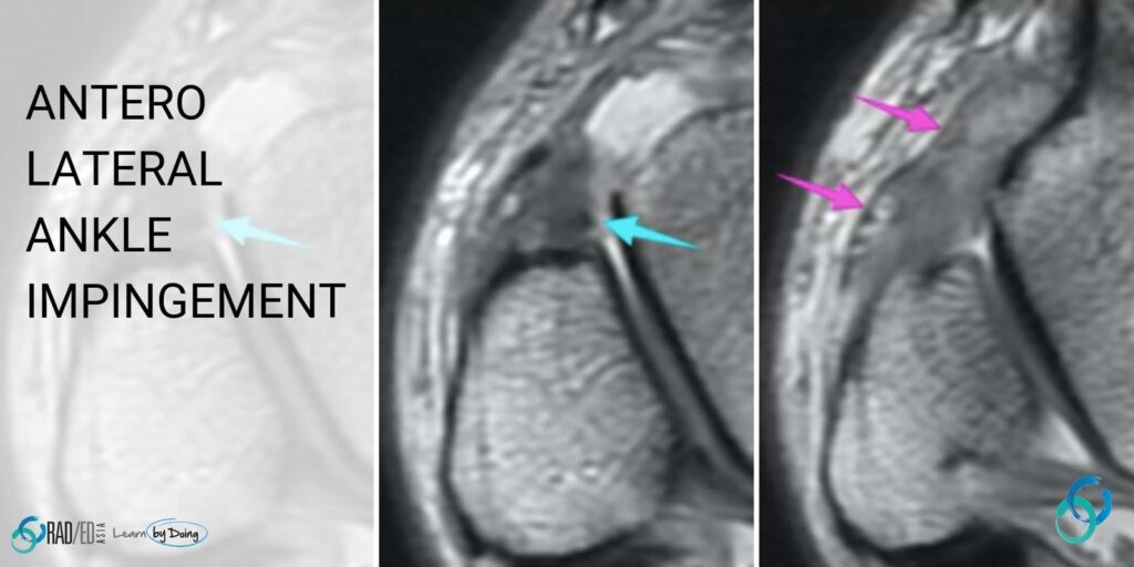 mri antero lateral ankle impingement radiology education asia