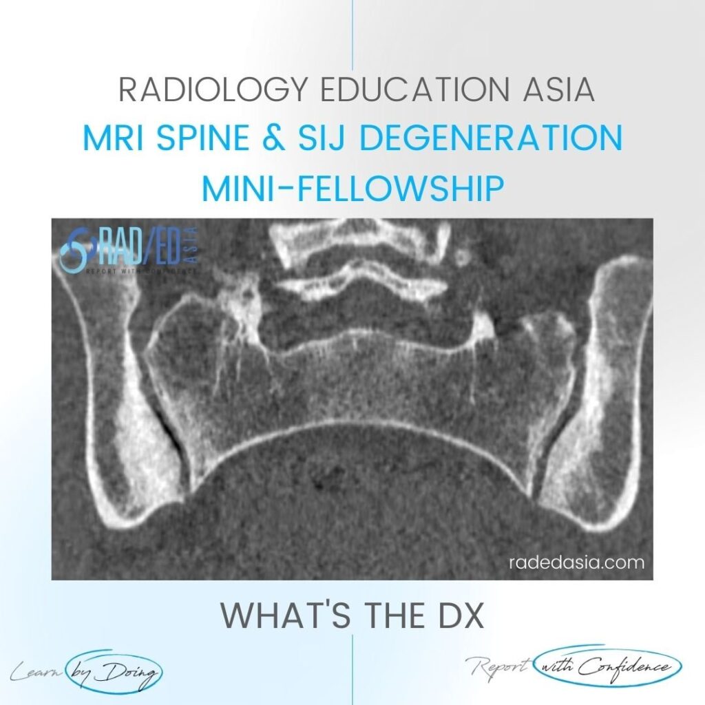 mri ct osteitis condensans ilii spine sij